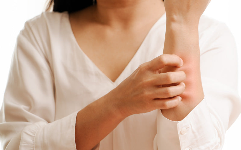10 Ways to Treat Eczema Naturally